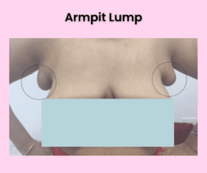 armpit-lump-treatment