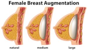 breast-augmentation-in-pune