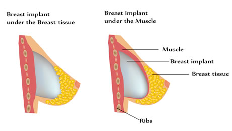 breast-implant-in-pune