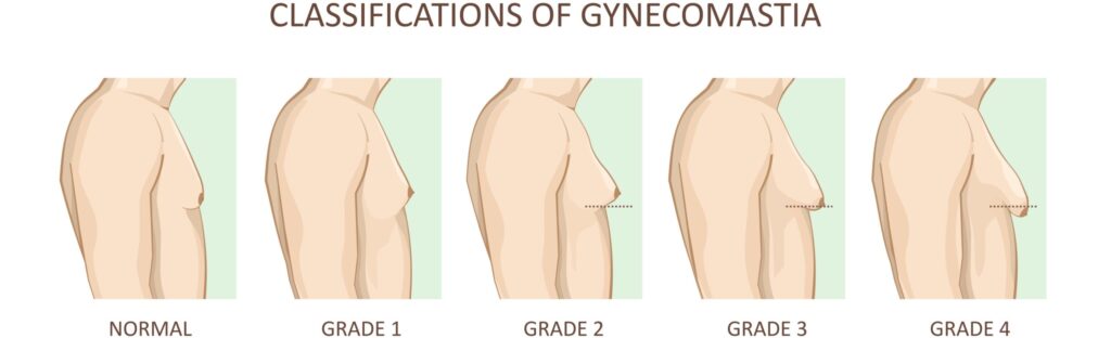 gynecomastia-surgery-in-pune