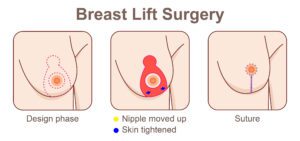 breast-lift-surgery-in-pune