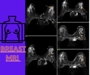 Breast MRI radiology with left breast lesion