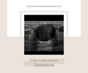 ultrasound picture of well defined benign fibroadenoma
