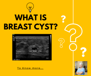 breast cyst